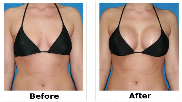 natural breast enhancement